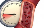 Особенности, течение и лечение артериальной гипотонии (код 195 по МКБ 10)