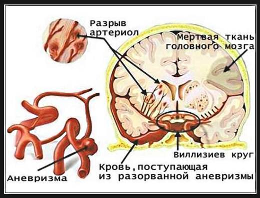 аневризма в мозге