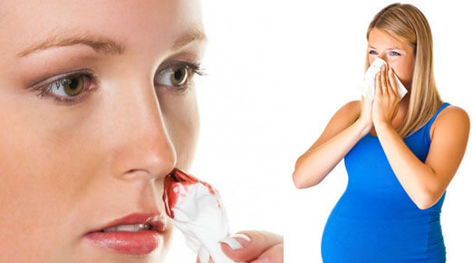 кровь из носа у беременной