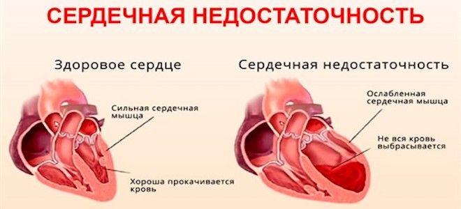 Гипертоническая болезнь и артериальная гипертензия разница thumbnail