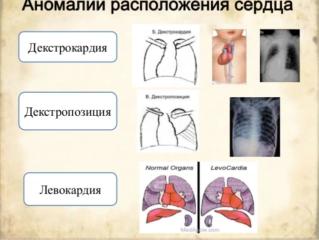 Расположение сердца у человека в грудной клетке: норма и патология
