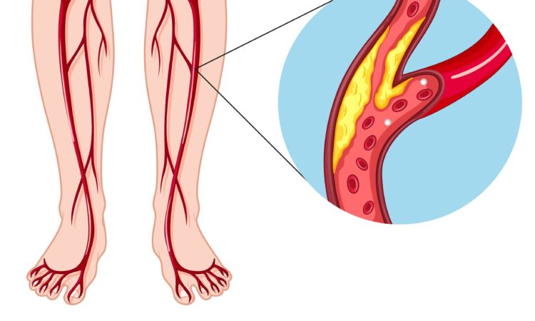 Про болезнь периферических артерий: диагностику, лечение и профилактику